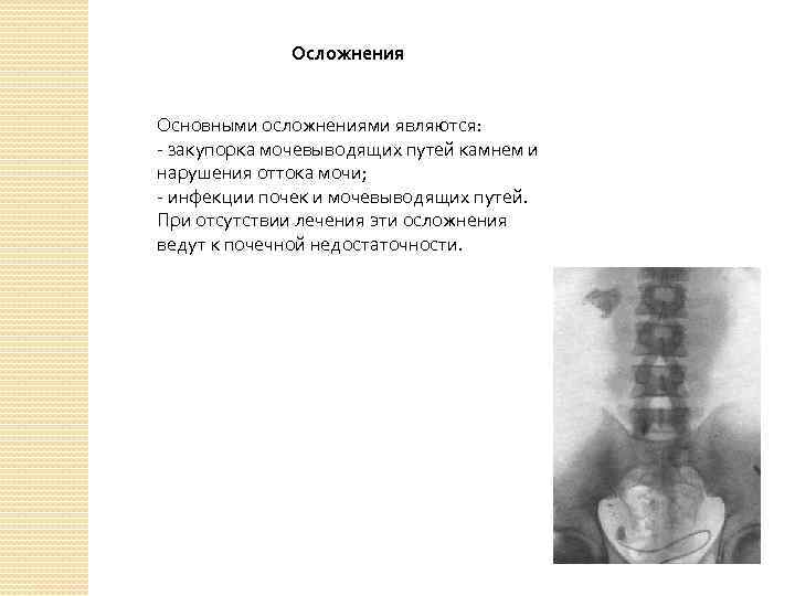 Осложнения Основными осложнениями являются: - закупорка мочевыводящих путей камнем и нарушения оттока мочи; -