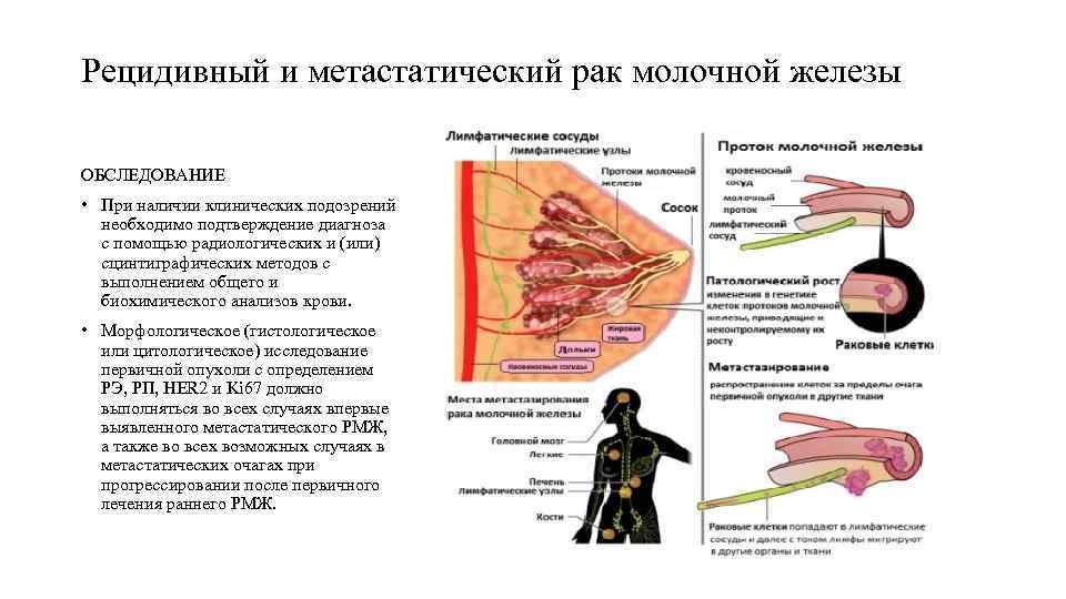 Рецидивный и метастатический рак молочной железы ОБСЛЕДОВАНИЕ • При наличии клинических подозрений необходимо подтверждение