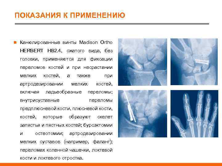 ПОКАЗАНИЯ К ПРИМЕНЕНИЮ n Канюлированные винты Madison Ortho HERBERT HB 2. 4, сжатого вида,