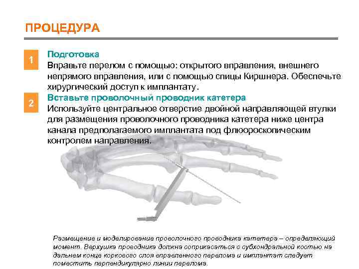 ПРОЦЕДУРА 1 2 Подготовка Вправьте перелом с помощью: открытого вправления, внешнего непрямого вправления, или