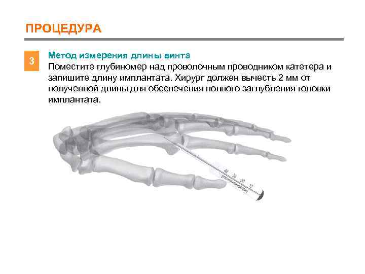 ПРОЦЕДУРА 3 Метод измерения длины винта Поместите глубиномер над проволочным проводником катетера и запишите