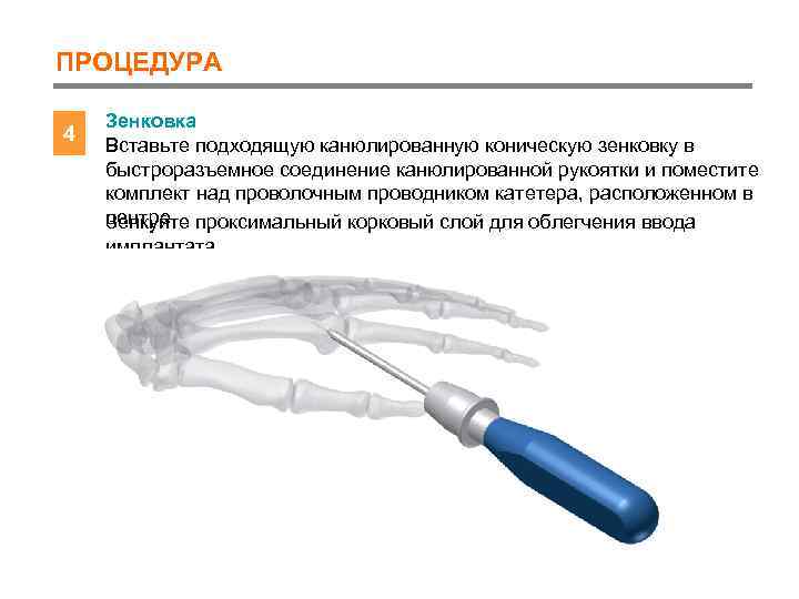 ПРОЦЕДУРА 4 Зенковка Вставьте подходящую канюлированную коническую зенковку в быстроразъемное соединение канюлированной рукоятки и