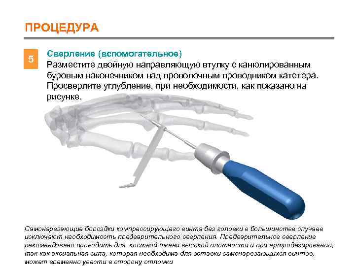 ПРОЦЕДУРА 5 Сверление (вспомогательное) Разместите двойную направляющую втулку с канюлированным буровым наконечником над проволочным