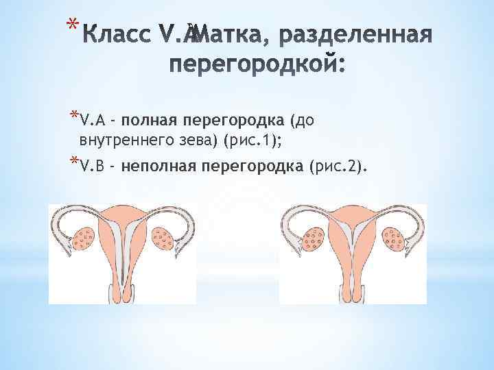 * *V. А - полная перегородка (до внутреннего зева) (рис. 1); *V. В -