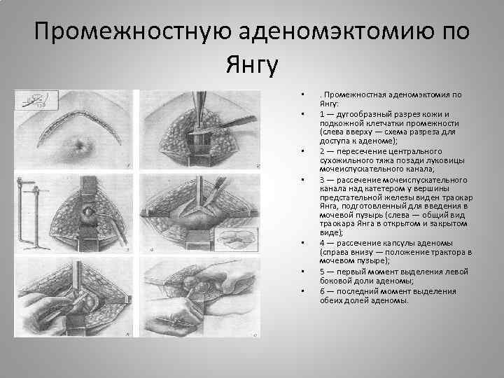 Промежностную аденомэктомию по Янгу • • . Промежностная аденомэктомия по Янгу: 1 — дугообразный