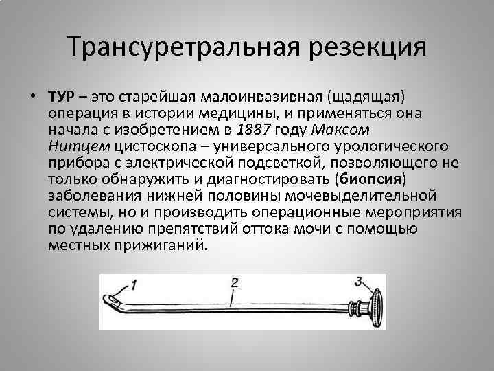 Трансуретральная резекция • ТУР – это старейшая малоинвазивная (щадящая) операция в истории медицины, и