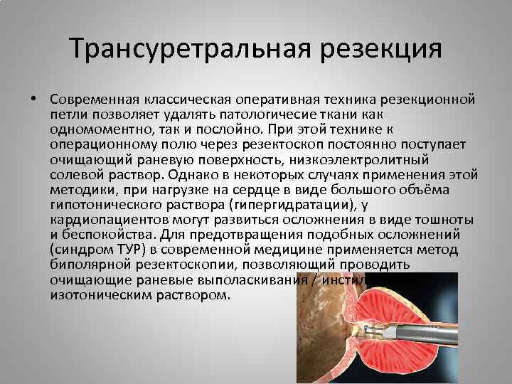 Трансуретральная резекция • Современная классическая оперативная техника резекционной петли позволяет удалять патологичесие ткани как