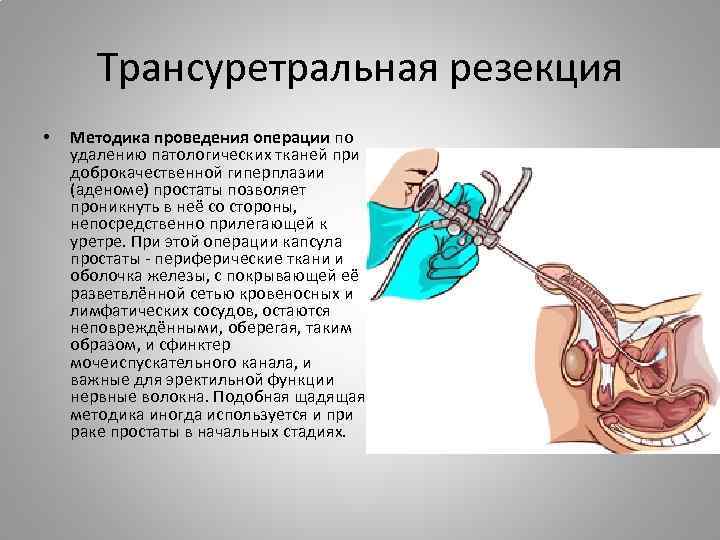 Трансуретральная резекция • Методика проведения операции по удалению патологических тканей при доброкачественной гиперплазии (аденоме)