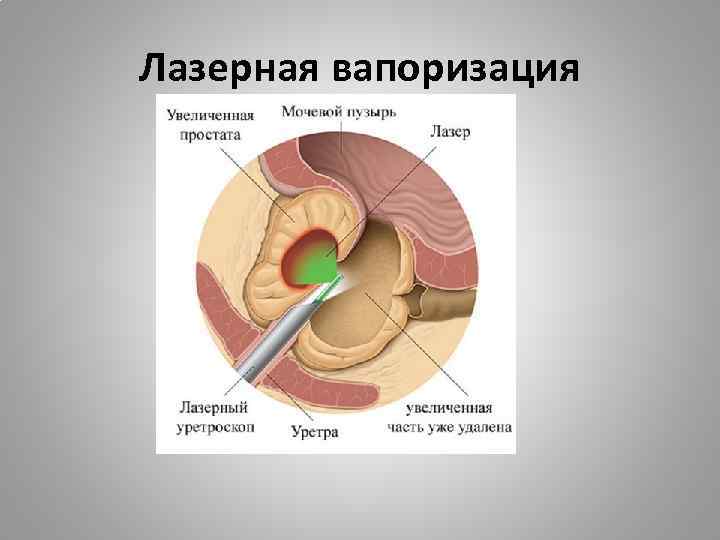 Лазерная вапоризация 