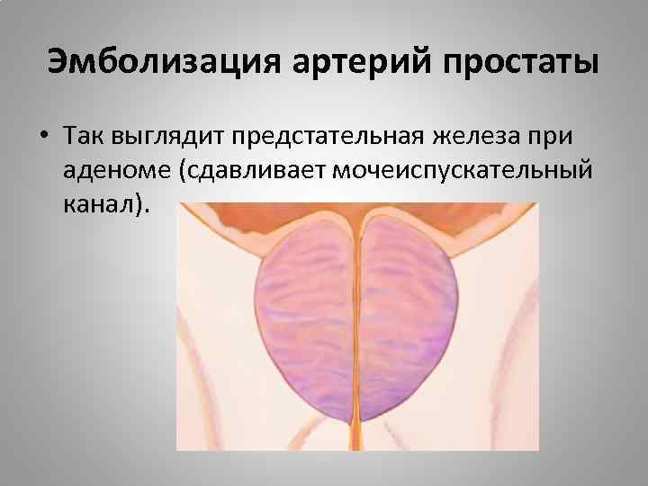 Эмболизация артерий простаты • Так выглядит предстательная железа при аденоме (сдавливает мочеиспускательный канал). 