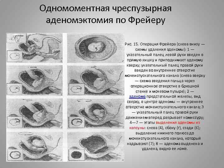 Одномоментная чреспузырная аденомэктомия по Фрейеру Рис. 15. Операция Фрейера (слева внизу — схемы удаления