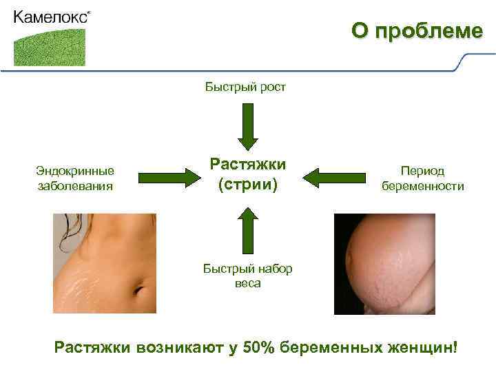 О проблеме Быстрый рост Эндокринные заболевания Растяжки (стрии) Период беременности Быстрый набор веса Растяжки