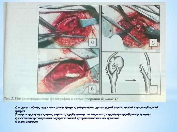 а) выделены общая, наружная и сонная артерии; аневризма отходит он задней стенки извитой внутренней
