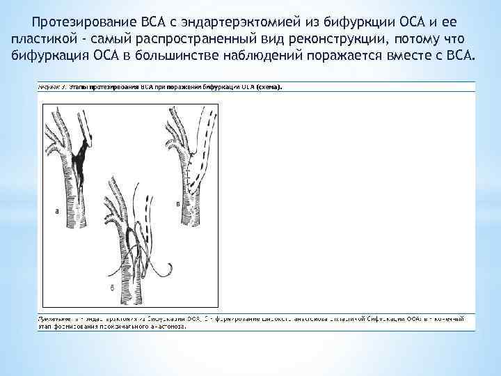 Протезирование ВСА с эндартерэктомией из бифуркции ОСА и ее пластикой - самый распространенный вид