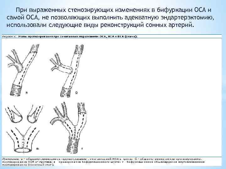 При выраженных стенозирующих изменениях в бифуркации ОСА и самой ОСА, не позволяющих выполнить адекватную