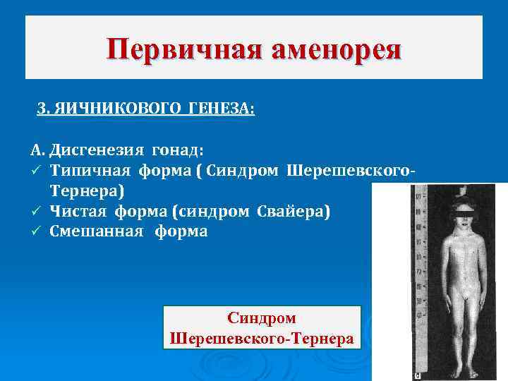 Первичная аменорея 3. ЯИЧНИКОВОГО ГЕНЕЗА: А. Дисгенезия гонад: ü Типичная форма ( Синдром Шерешевского.