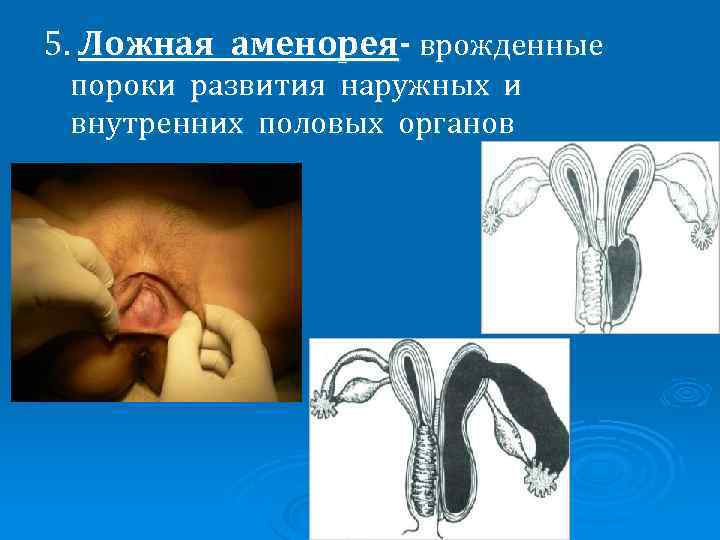 5. Ложная аменорея- врожденные пороки развития наружных и внутренних половых органов 