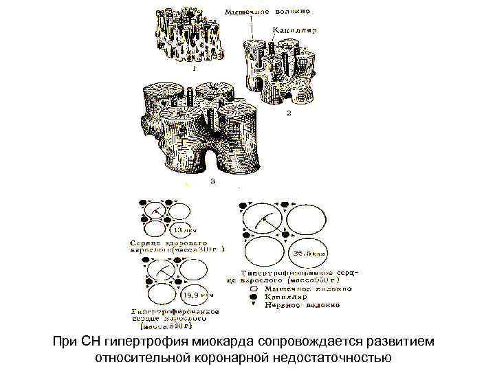 При СН гипертрофия миокарда сопровождается развитием относительной коронарной недостаточностью 