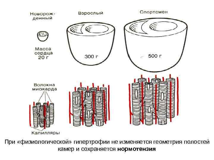 При «физиологической» гипертрофии не изменяется геометрия полостей камер и сохраняется нормотензия 