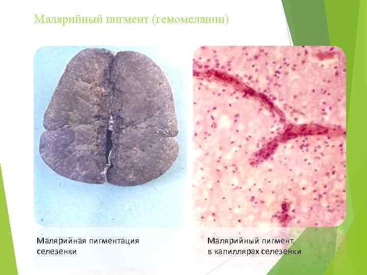 Малярийный пигмент (гемомеланин) Малярийная пигментация селезенки Малярийный пигмент в капиллярах селезенки 