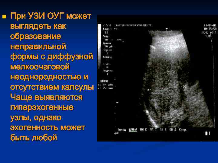 Повышенная эхогенность печени. Очаговая гиперплазия печени на УЗИ. Очаговая Узловая гиперплазия печени на УЗИ. Узловая гиперплазия печени на УЗИ. Узловая гиперплазия печени при ультразвуковом исследовании.