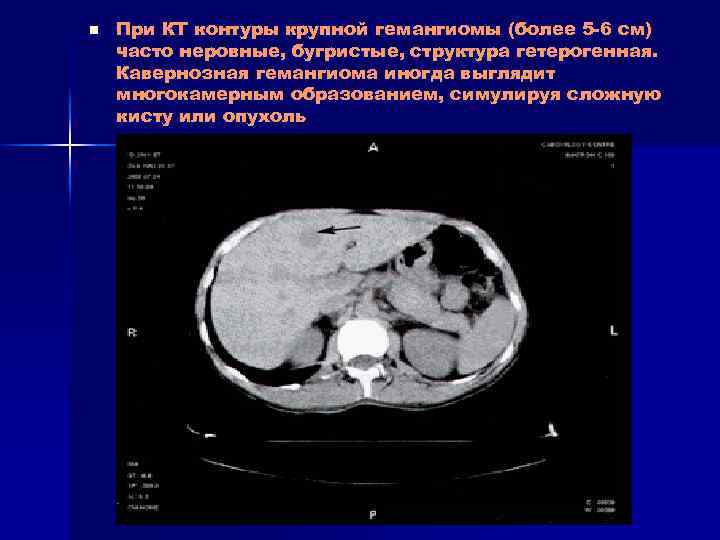 Эхографическую картину кавернозной гемангиомы печени необходимо дифференцировать с