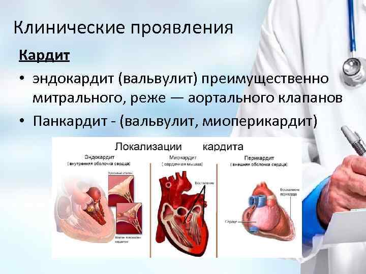 Клинические проявления Кардит • эндокардит (вальвулит) преимущественно митрального, реже — аортального клапанов • Панкардит