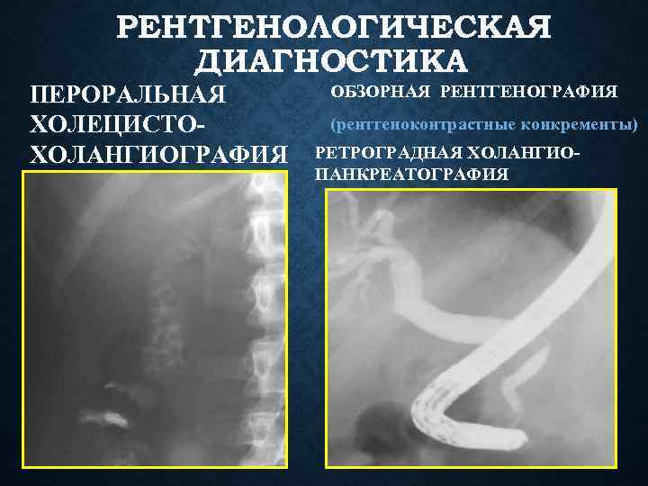 РЕНТГЕНОЛОГИЧЕСКАЯ ДИАГНОСТИКА ПЕРОРАЛЬНАЯ ХОЛЕЦИСТОХОЛАНГИОГРАФИЯ ОБЗОРНАЯ РЕНТГЕНОГРАФИЯ (рентгеноконтрастные конкременты) РЕТРОГРАДНАЯ ХОЛАНГИОПАНКРЕАТОГРАФИЯ 