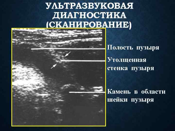 УЛЬТРАЗВУКОВАЯ ДИАГНОСТИКА (СКАНИРОВАНИЕ) Полость пузыря Утолщенная стенка пузыря Камень в области шейки пузыря 