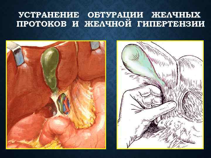 УСТРАНЕНИЕ ОБТУРАЦИИ ЖЕЛЧНЫХ ПРОТОКОВ И ЖЕЛЧНОЙ ГИПЕРТЕНЗИИ 