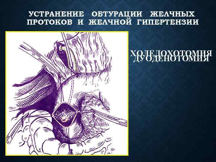 УСТРАНЕНИЕ ОБТУРАЦИИ ЖЕЛЧНЫХ ПРОТОКОВ И ЖЕЛЧНОЙ ГИПЕРТЕНЗИИ ХОЛЕДОХОТОМИЯ ДУОДЕНОТОМИЯ 