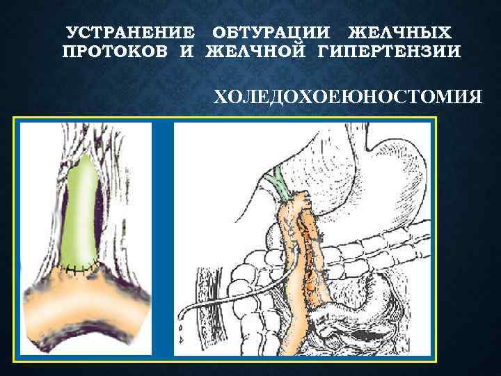 УСТРАНЕНИЕ ОБТУРАЦИИ ЖЕЛЧНЫХ ПРОТОКОВ И ЖЕЛЧНОЙ ГИПЕРТЕНЗИИ ХОЛЕДОХОЕЮНОСТОМИЯ 