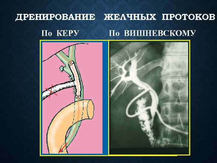 ДРЕНИРОВАНИЕ ЖЕЛЧНЫХ ПРОТОКОВ По КЕРУ По ВИШНЕВСКОМУ 