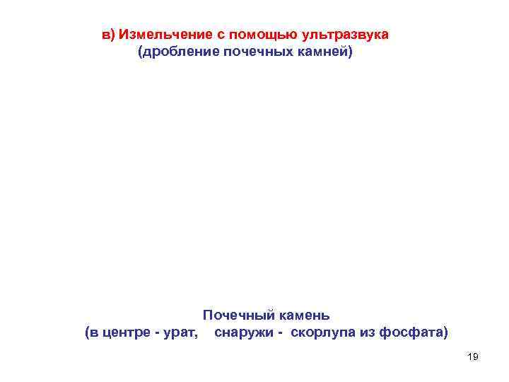 в) Измельчение с помощью ультразвука (дробление почечных камней) Почечный камень (в центре - урат,