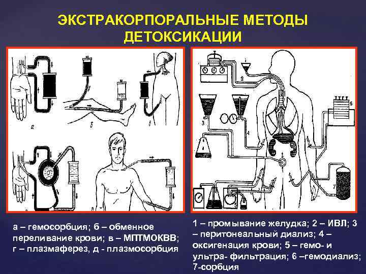 ЭКСТРАКОРПОРАЛЬНЫЕ МЕТОДЫ ДЕТОКСИКАЦИИ а – гемосорбция; б – обменное переливание крови; в – МПТМОКВВ;