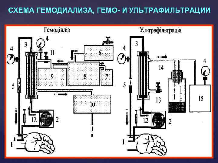 СХЕМА ГЕМОДИАЛИЗА, ГЕМО- И УЛЬТРАФИЛЬТРАЦИИ 