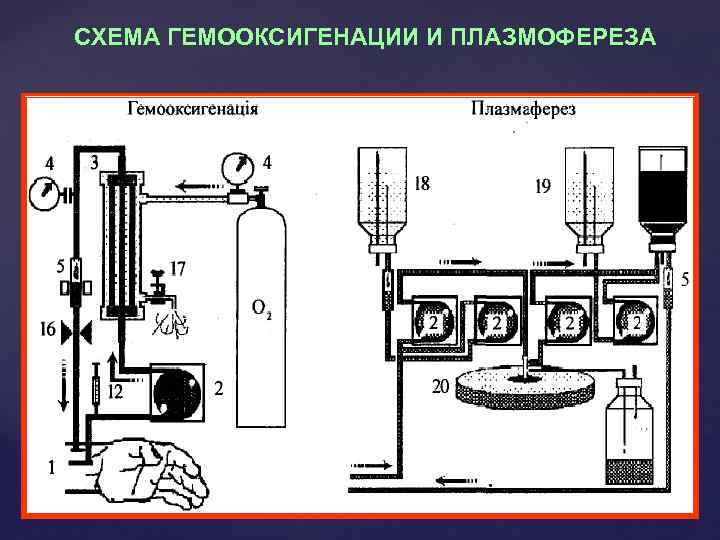 СХЕМА ГЕМООКСИГЕНАЦИИ И ПЛАЗМОФЕРЕЗА 