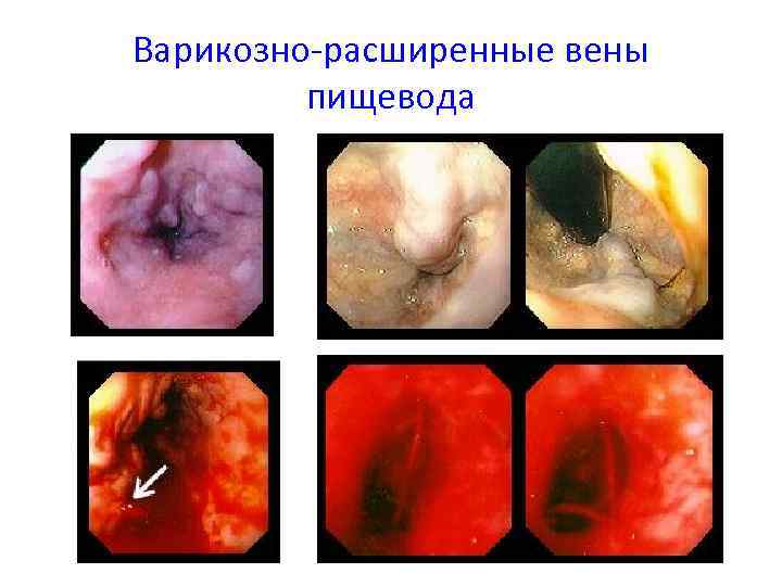 Варикозно-расширенные вены пищевода 