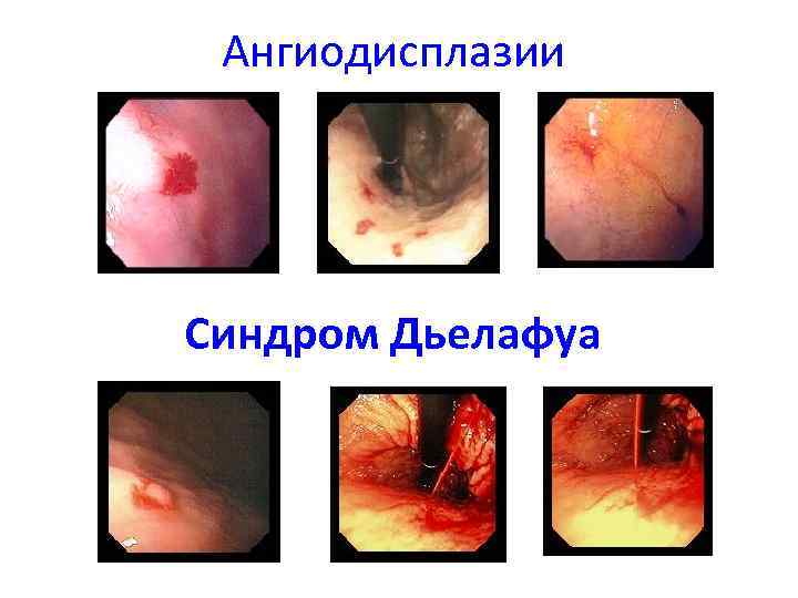 Ангиодисплазии Синдром Дьелафуа 