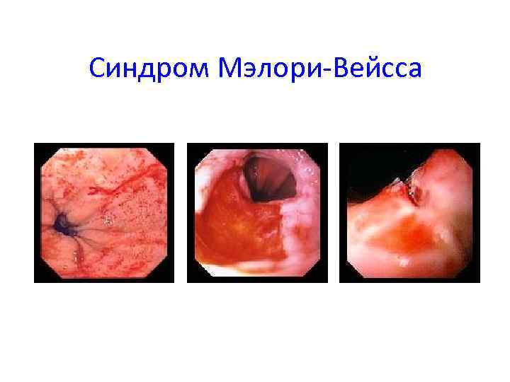 Синдром Мэлори-Вейсса 