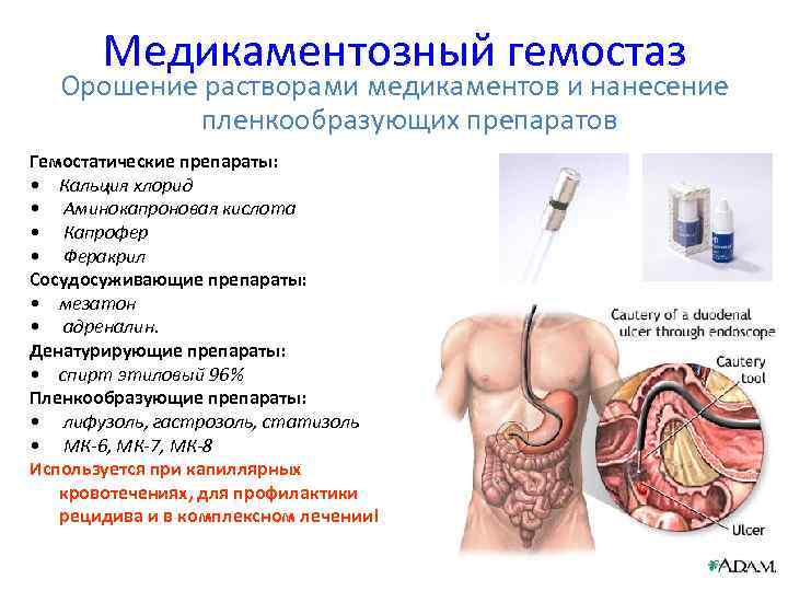 Медикаментозный гемостаз Орошение растворами медикаментов и нанесение пленкообразующих препаратов Гемостатические препараты: • Кальция хлорид