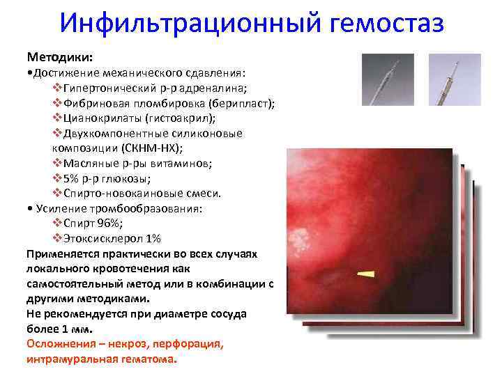Инфильтрационный гемостаз Методики: • Достижение механического сдавления: v. Гипертонический р-р адреналина; v. Фибриновая пломбировка