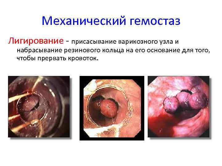 Механический гемостаз Лигирование - присасывание варикозного узла и набрасывание резинового кольца на его основание