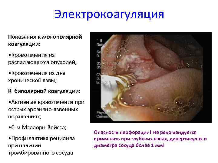 Электрокоагуляция Показания к монополярной коагуляции: • Кровотечения из распадающихся опухолей; • Кровотечения из дна
