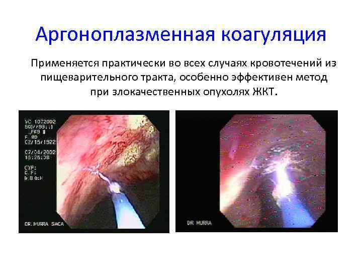 Аргоноплазменная коагуляция Применяется практически во всех случаях кровотечений из пищеварительного тракта, особенно эффективен метод