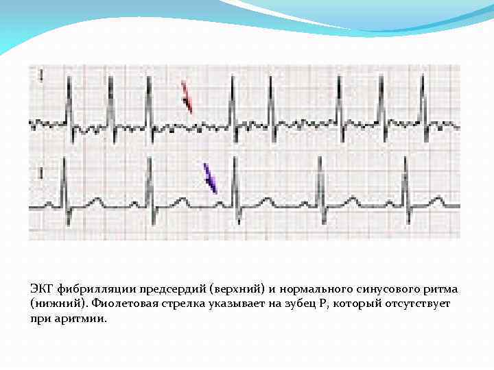 ЭКГ фибрилляции предсердий (верхний) и нормального синусового ритма (нижний). Фиолетовая стрелка указывает на зубец
