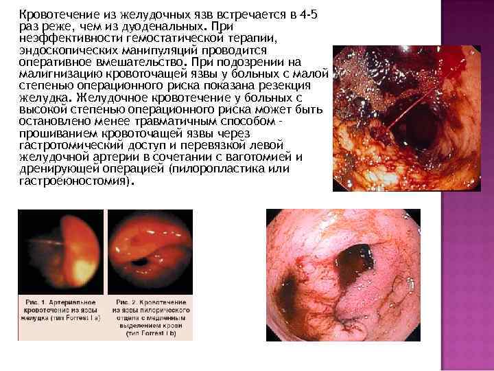 Кровотечение из желудочных язв встречается в 4 -5 раз реже, чем из дуоденальных. При