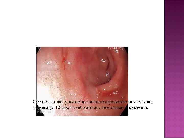 Остановка желудочно-кишечного кровотечения из язвы луковицы 12 -перстной кишки с помощью эндоскопа. 