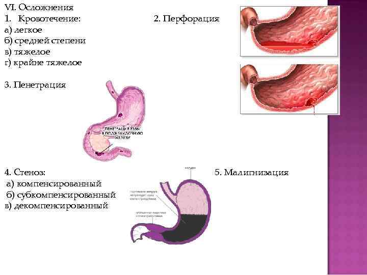 VI. Осложнения 1. Кровотечение: а) легкое б) средней степени в) тяжелое г) крайне тяжелое