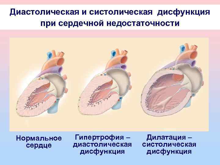 Сердечная недостаточность патофизиология презентация
